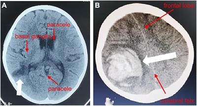 Case Report: Report of Infective Endocarditis Caused by Abiotrophia defectiva and Literature Review